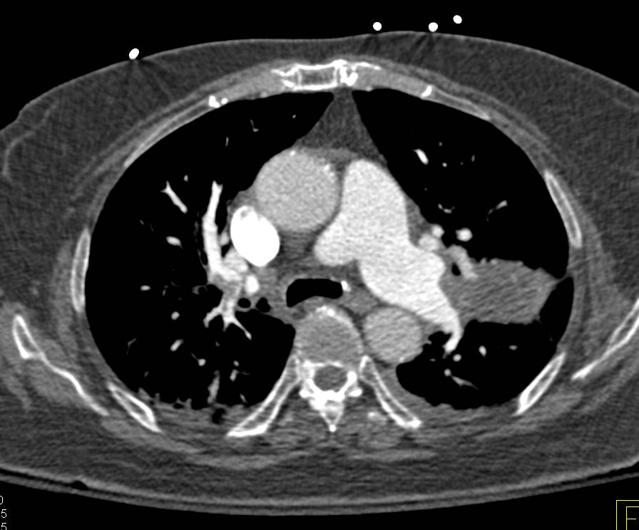Pulmonary Embolism (PE) (Right Upper Lobe) in Patient with Lung Cancer with Lymphangitic Spread - CTisus CT Scan