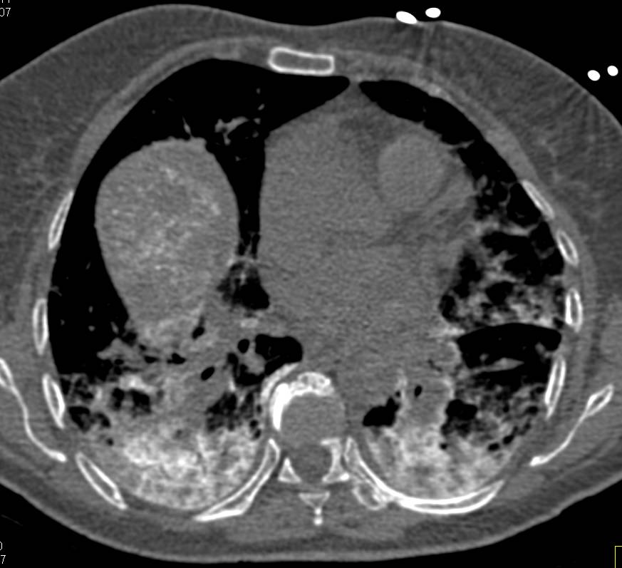 S/P TACE Procedure Liver with Contrast in the Lung - CTisus CT Scan