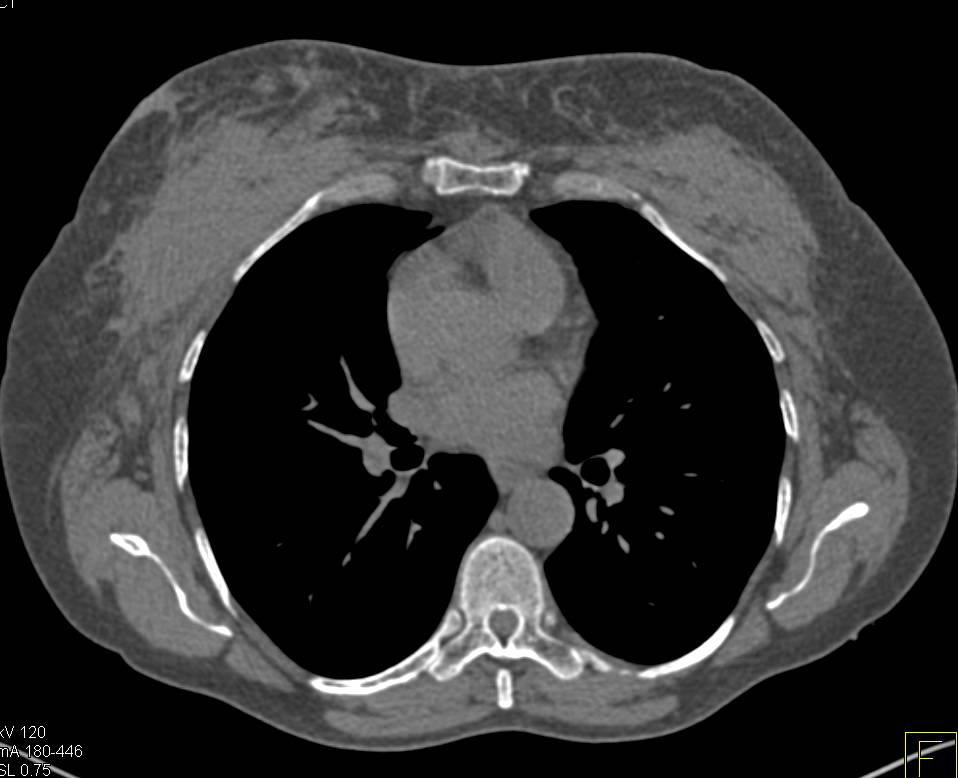 Silicone Injected into Male Breasts - CTisus CT Scan