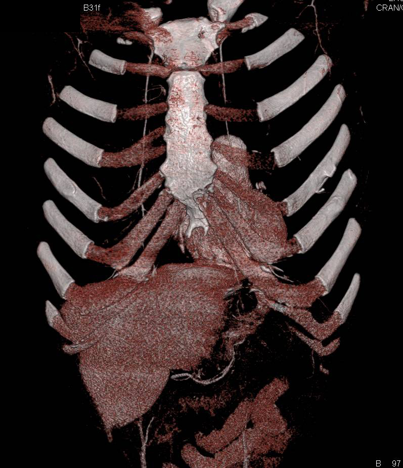 Pectus Deformity - CTisus CT Scan