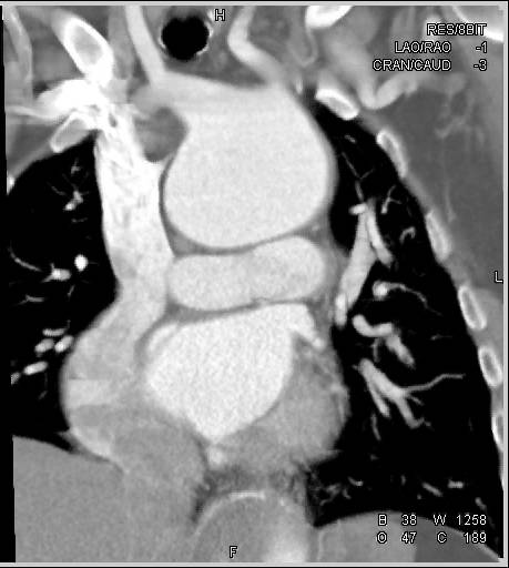 Type B Dissection Following Type A Dissection Repair - CTisus CT Scan