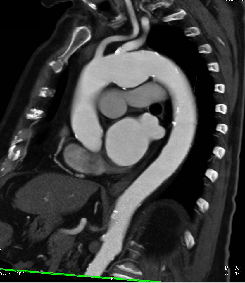 3D Mapping of a Focal Aneurysm of the Aprtic Arch - CTisus CT Scan