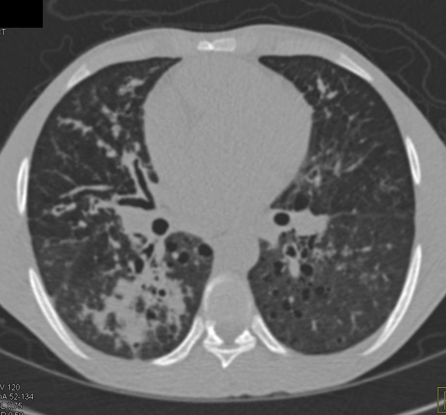 Lymphangioleiomyomatosis (LAM) with Air Trapping - CTisus CT Scan