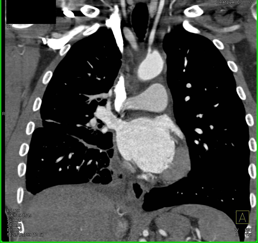 Lymphangitic Spread Right Lung - CTisus CT Scan