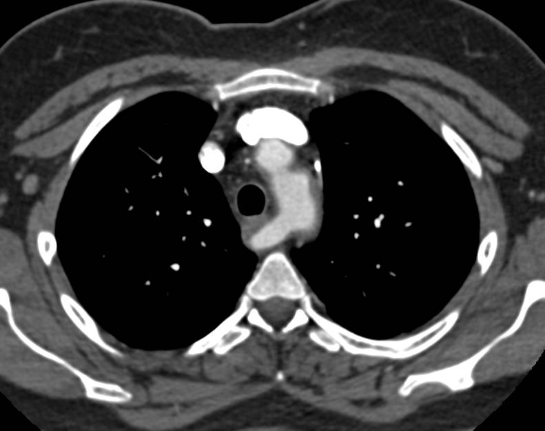 Aberrant Right Subclavian Artery - CTisus CT Scan