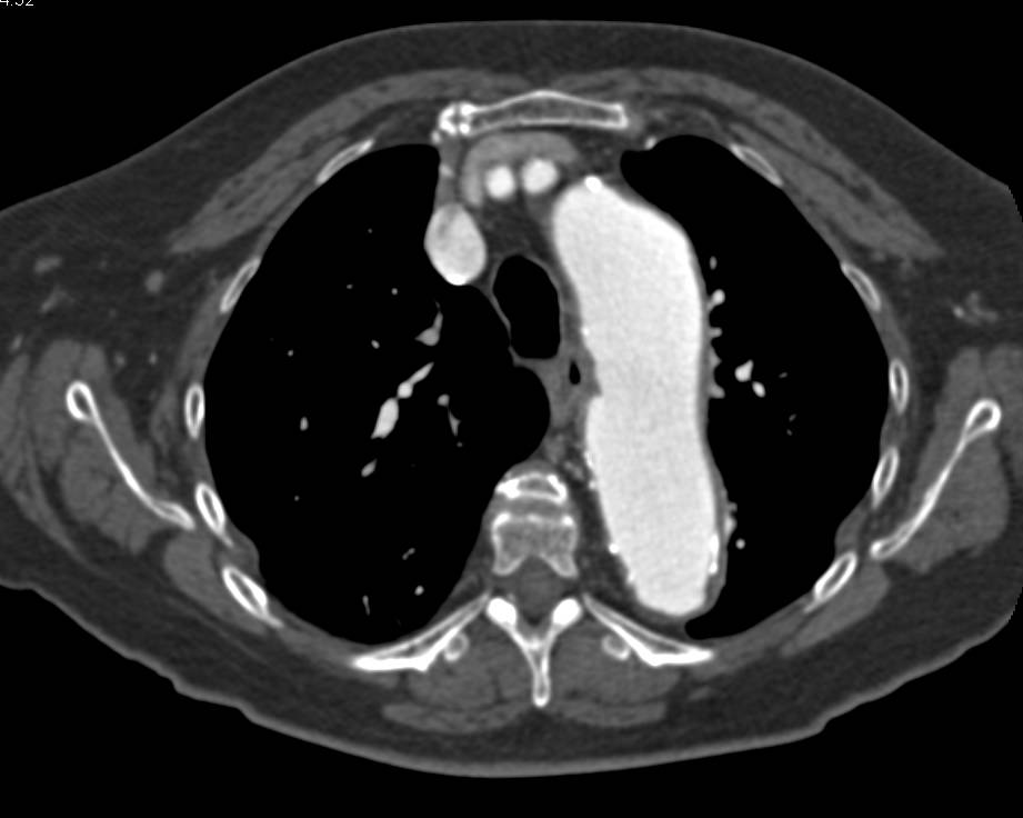 Aberrant Right Subclavian Artery with Dilatation at Origin - CTisus CT Scan