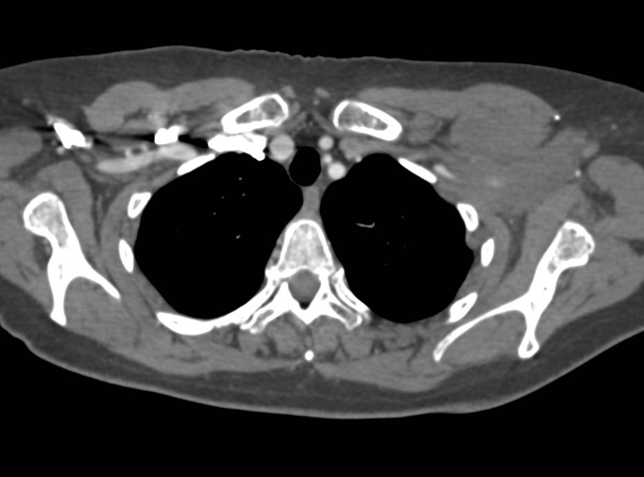 Lymphoma with Nodes in the Left Axilla - CTisus CT Scan