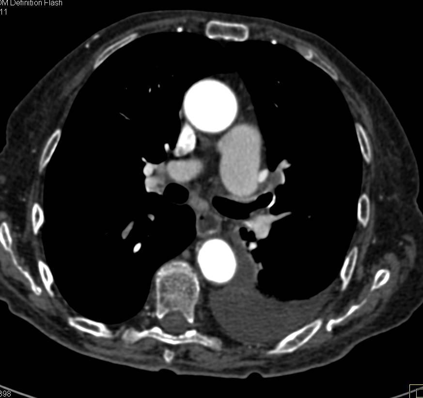 Pulmonary Embolism - CTisus CT Scan