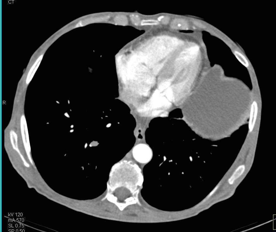 Incidental Pulmonary Embolism (PE) in the Pulmonary Artery to Right Lower Lung in a Patient with Metastatic Pancreatic Cancer - CTisus CT Scan