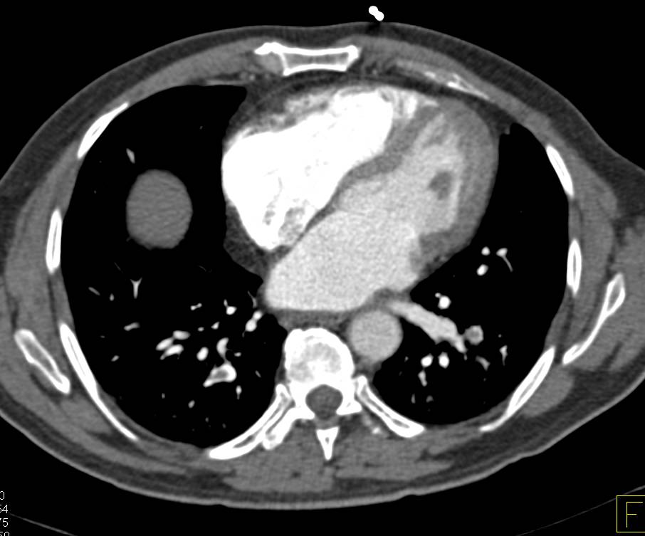 Pulmonary Embolism - CTisus CT Scan