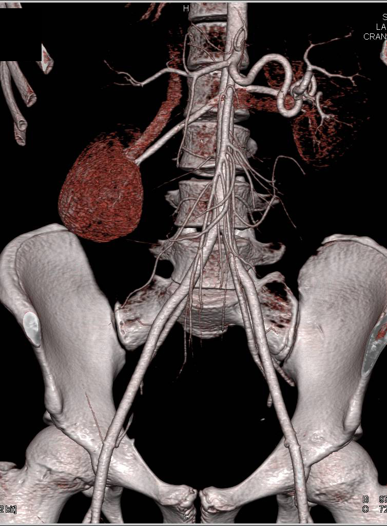 Enlarged Main Pulmonary Artery - CTisus CT Scan