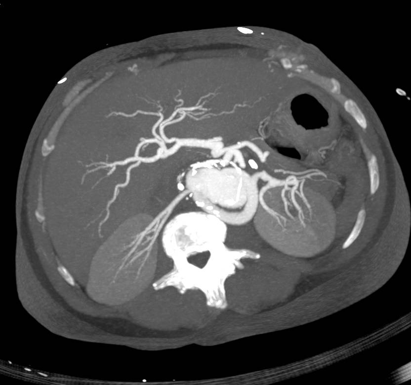 Complex Repair of Descending Thoracic Aorta - CTisus CT Scan