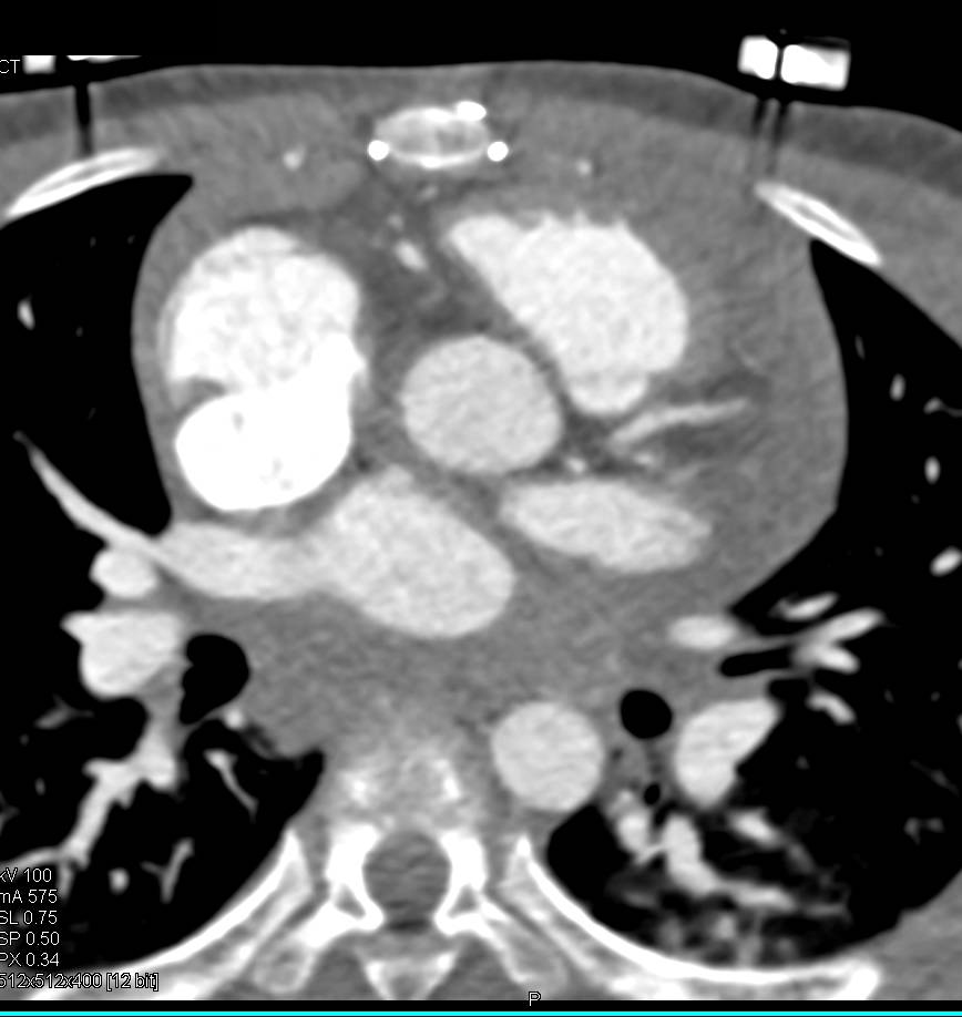 Contrast in Superior Vena Cava (SVC) - CTisus CT Scan