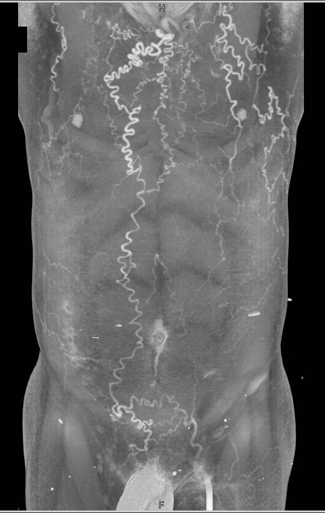 Innominate Vein and Inferior Vena Cava (IVC) Occlusion with Collaterals - CTisus CT Scan