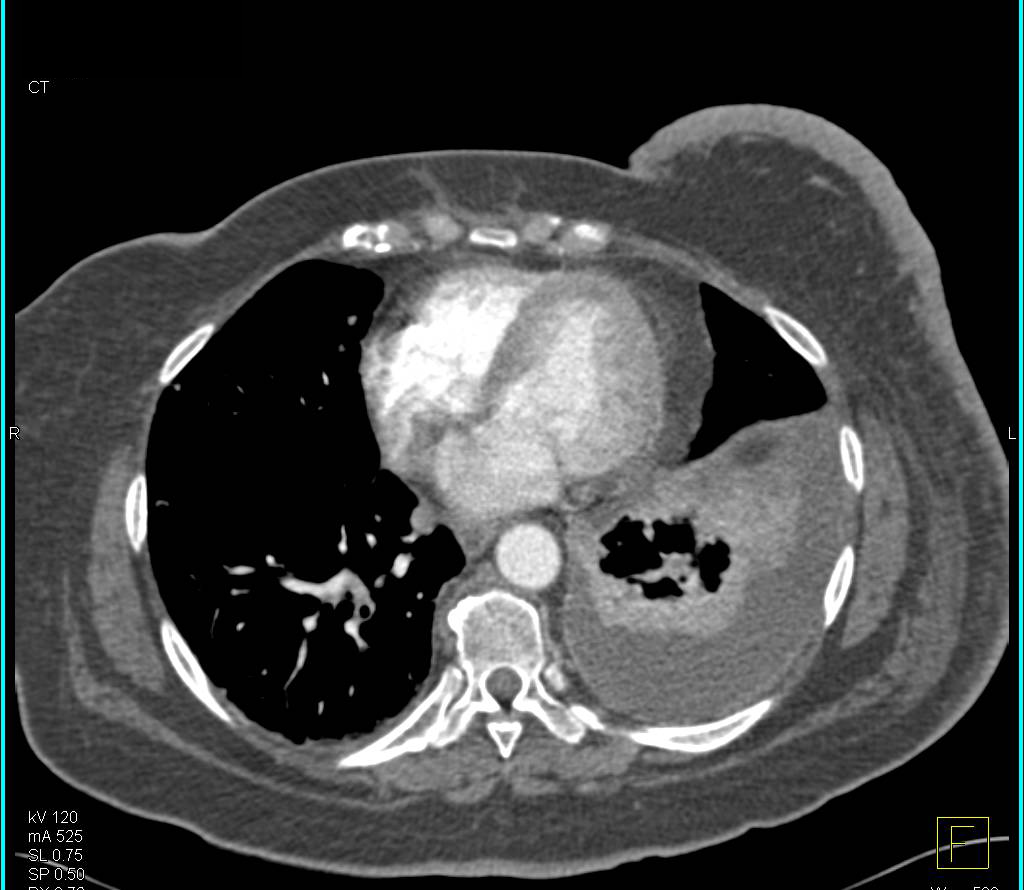 Inflammatory Breast Cancer with Pleural Metastases - CTisus CT Scan