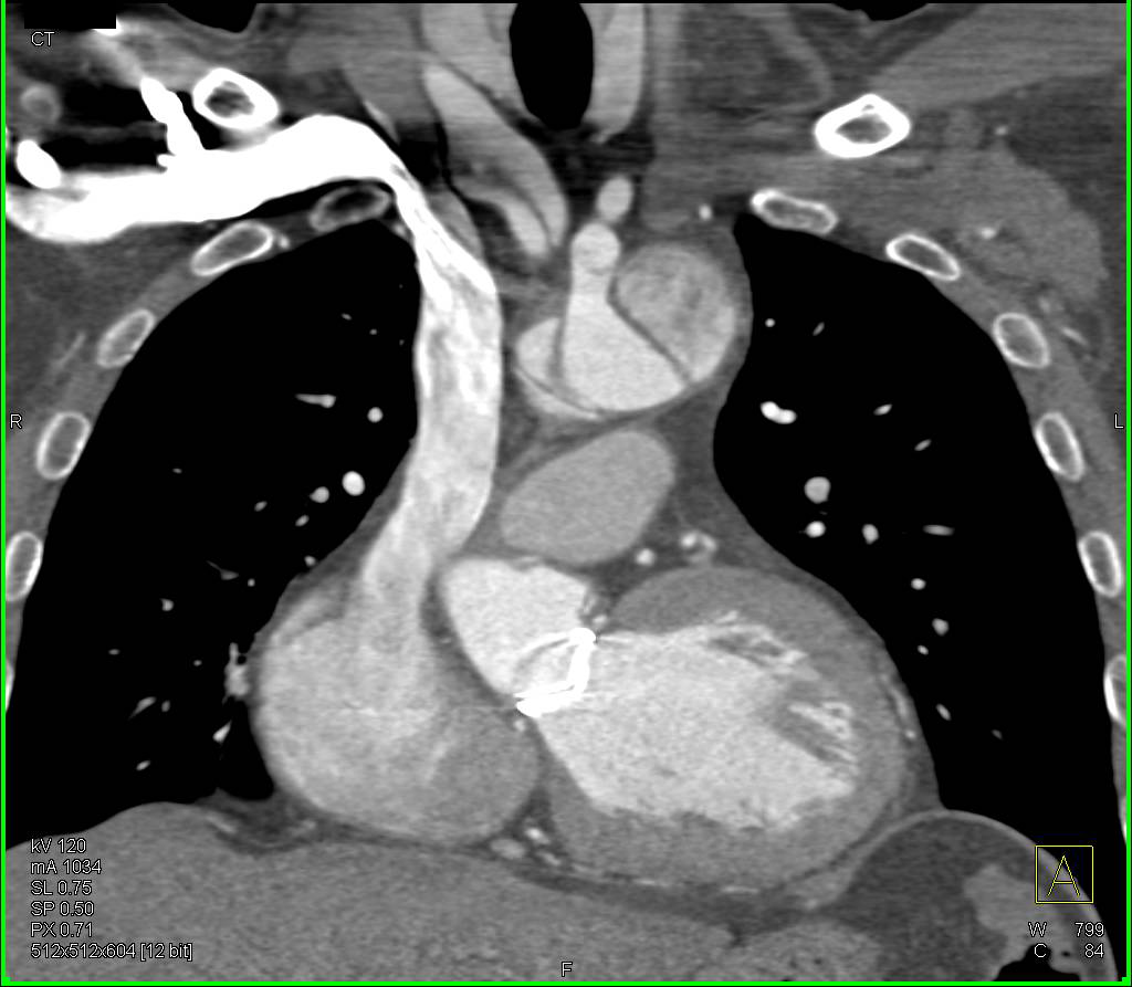 Type A Dissection with Prior Root Repair and Now Dissection in Descending Thoracic Aorta with Compressed True Lumen - CTisus CT Scan