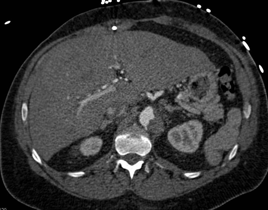 Left Ventricular Assist Device (LVAD) in 3D for Evaluation - CTisus CT Scan