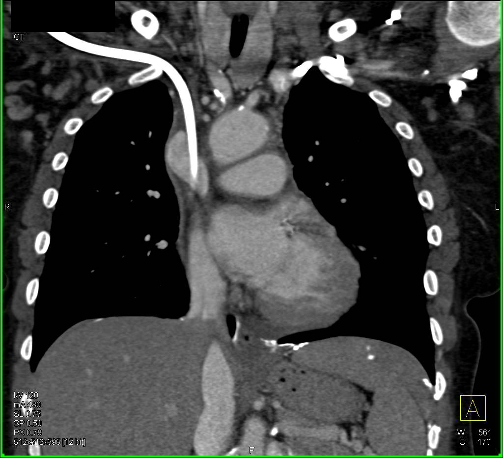 Superior Vena Cava (SVC) Stenosis with Collaterals - CTisus CT Scan