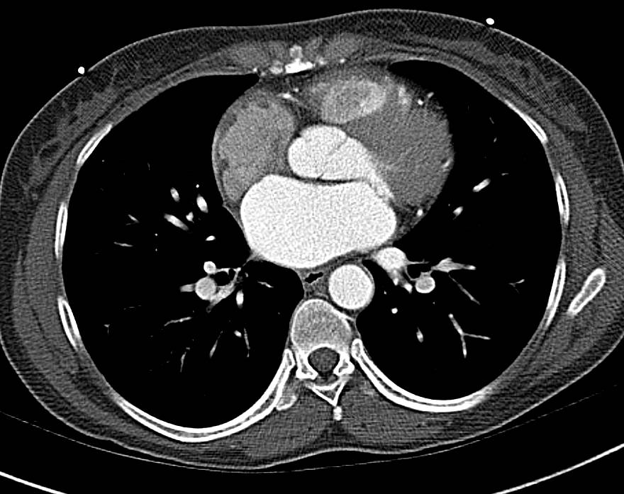 High Resolution Images Create a Pseudo-Pulmonary Embolism (PE) Type Appearance - CTisus CT Scan