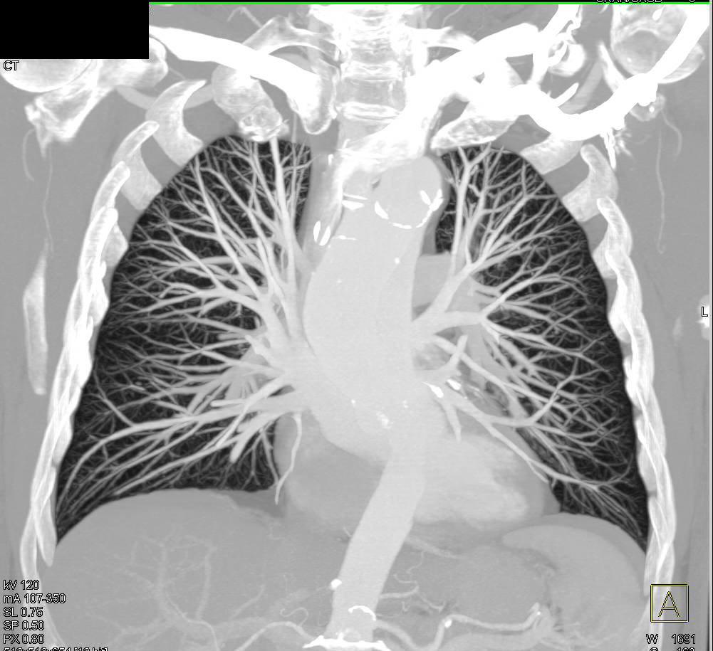 MIP of Normal Pulmonary Vasculature - CTisus CT Scan