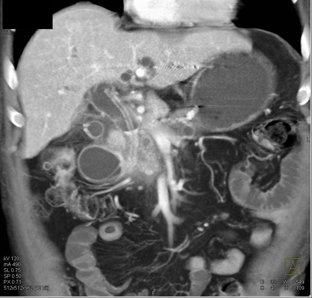 Pulmonary Embolism in Pulmonary Artery to Right Lower Lung in a Patient with Pancreatic Cancer - CTisus CT Scan