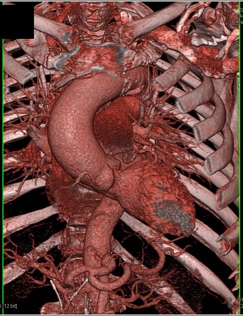 Dilated Aortic Root and Ascending Aorta - CTisus CT Scan