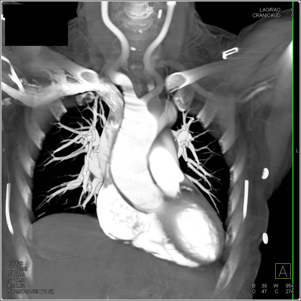 Bovine Arch - CTisus CT Scan