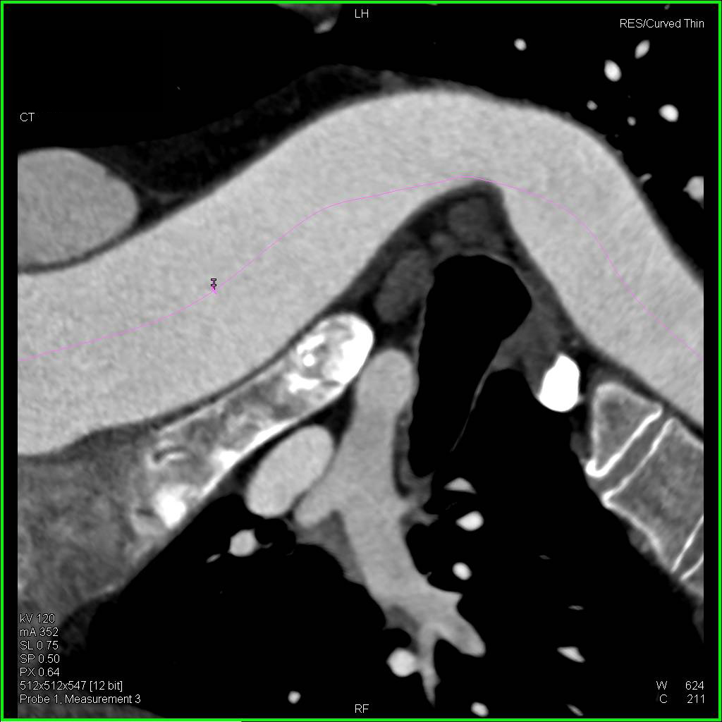 3D Vascular Map of Aortic Arch - CTisus CT Scan