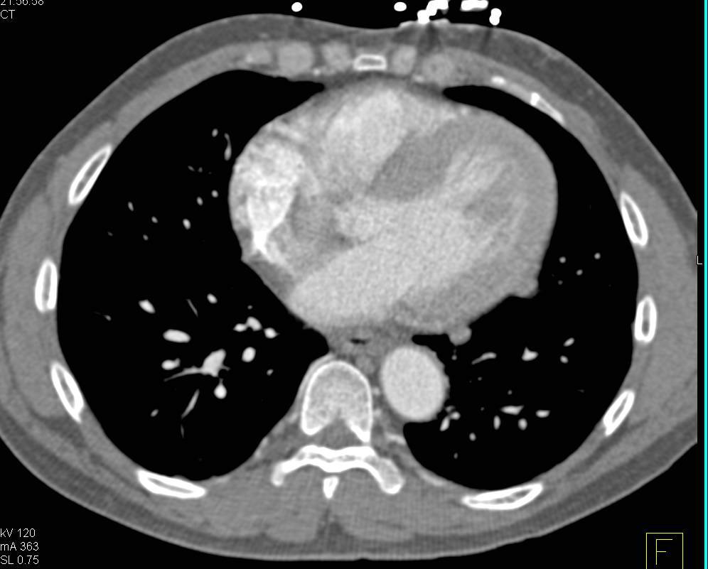 Splenosis Left Chest - CTisus CT Scan