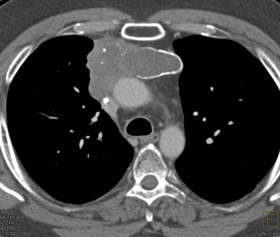 Thymoma with Calcification - CTisus CT Scan