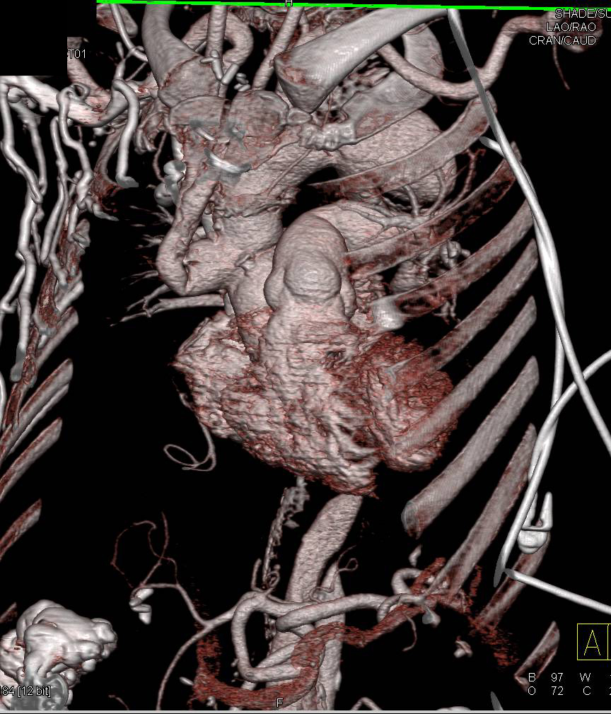 Complex Thoracic Aortic Aneurysm Repair with Grafts and Reimplantation of Arch Vessels - CTisus CT Scan