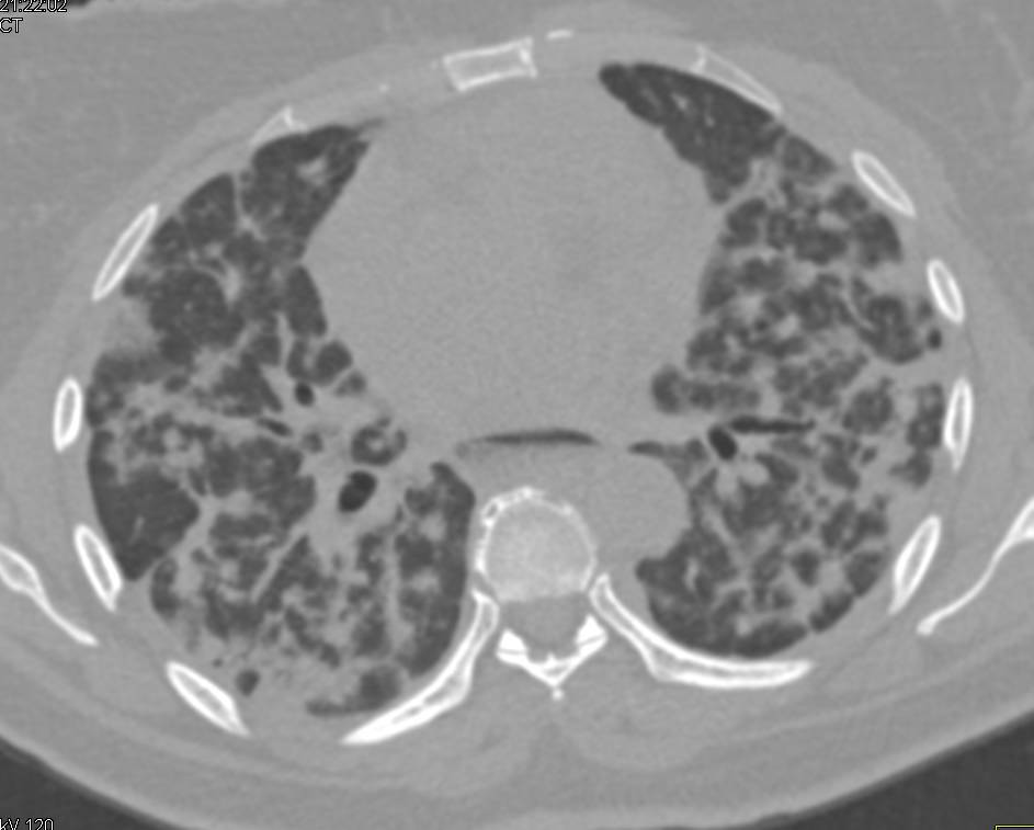 HRCT with Inflammation in the Lung Parenchyma - CTisus CT Scan