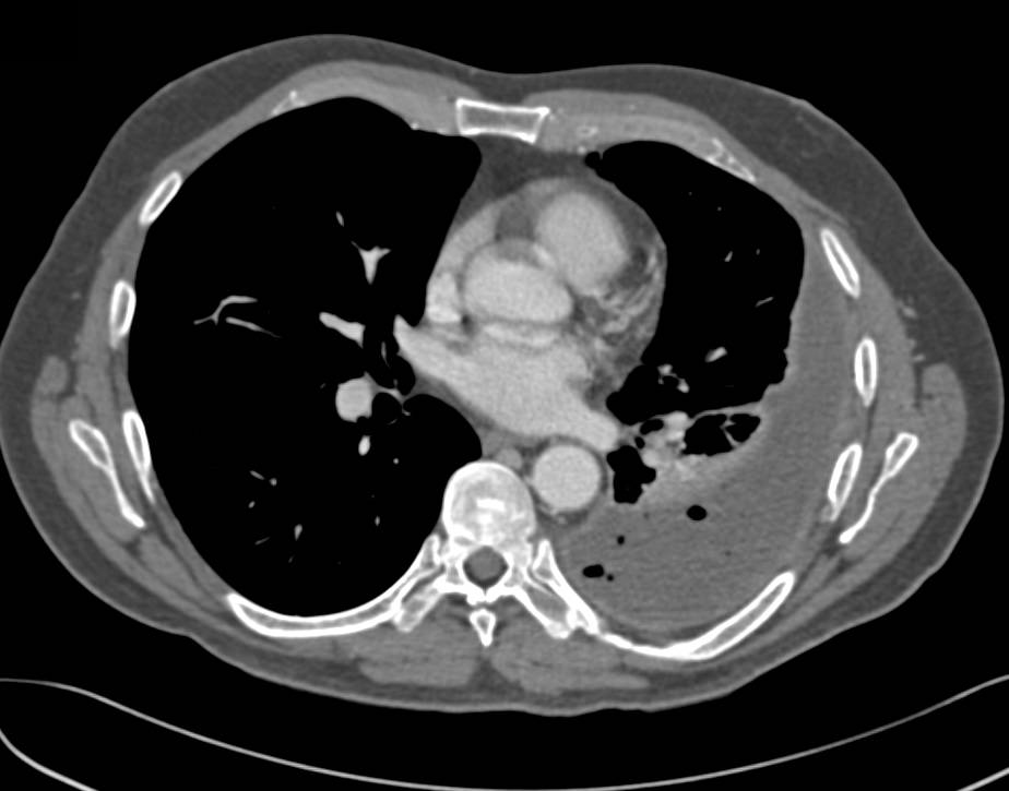 Emphyema Left Chest with Widespread Bone Mets - CTisus CT Scan