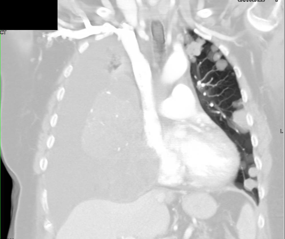 Lung Cancer with Adenopathy and Lung Metastases - CTisus CT Scan
