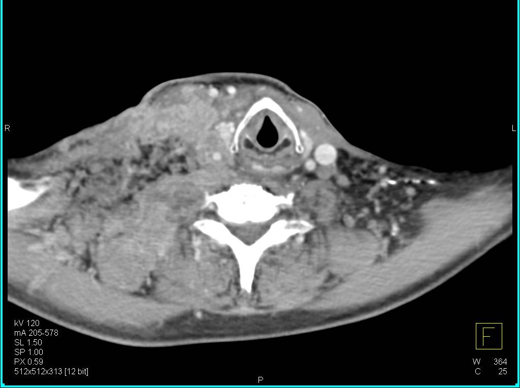 Lung Cancer with Extensive Adenopathy Especially in the Right Supra-Clavicular Zone - CTisus CT Scan