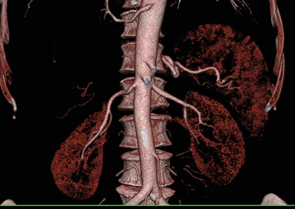 Annomalous Artery off Aorta to Left Lower Lung - CTisus CT Scan