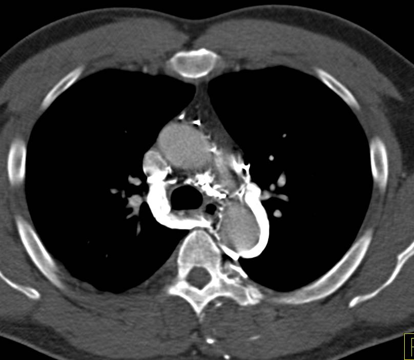 Left Innominate Vein Obstruction with Collaterals Including Left Superior Intercostal Vein - CTisus CT Scan