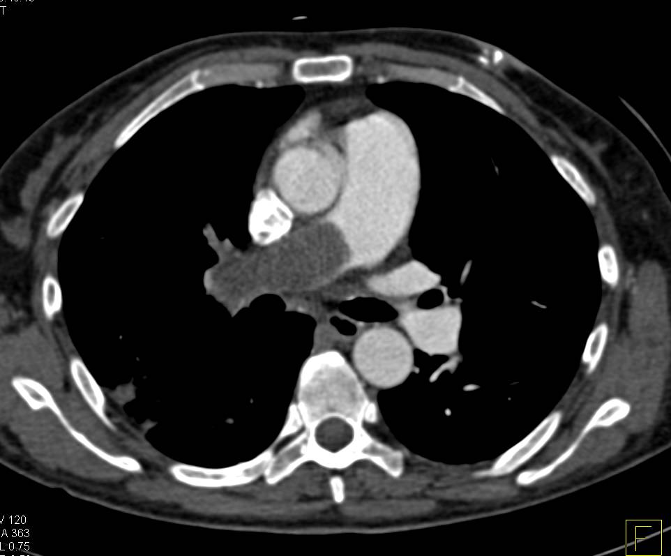 Large Pulmonary Embolism with Lung Infarct and Splenic Infarct - CTisus CT Scan