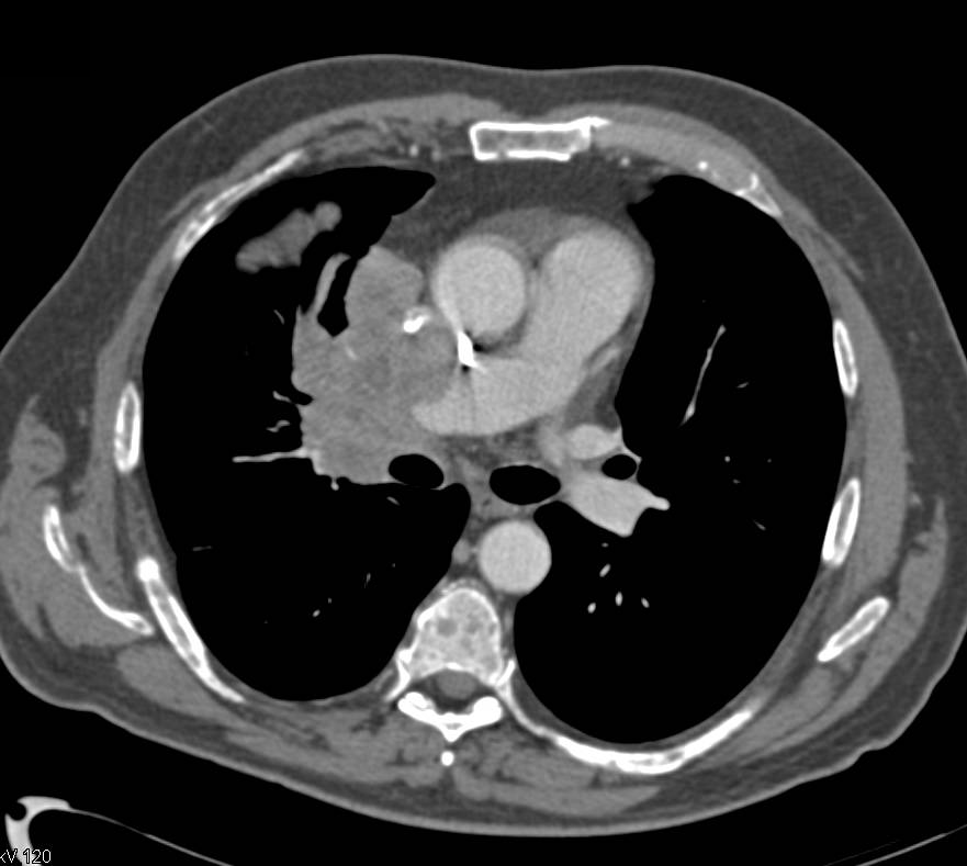 Small Cell Lung Cancer with Paratracheal Adenopathy - CTisus CT Scan