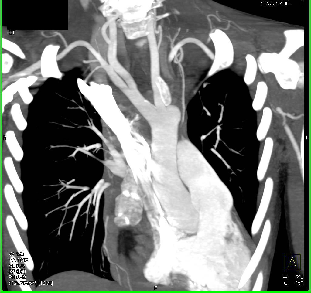 Marfan Syndrome with Severe Pectus Deformity - CTisus CT Scan