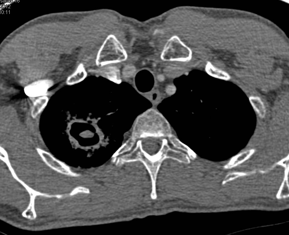 Cavity with Aspergilloma Right Apex - CTisus CT Scan