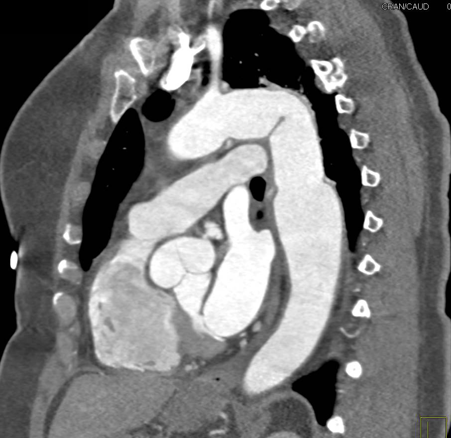 Aortic Arch Repair in 3D VRT - CTisus CT Scan