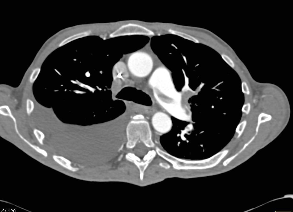 Pulmonary Embolism and Infarction in Post Operative Patient - CTisus CT Scan