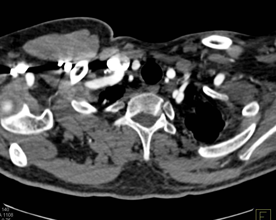 Focal Dissection Left Subclavian Artery - CTisus CT Scan