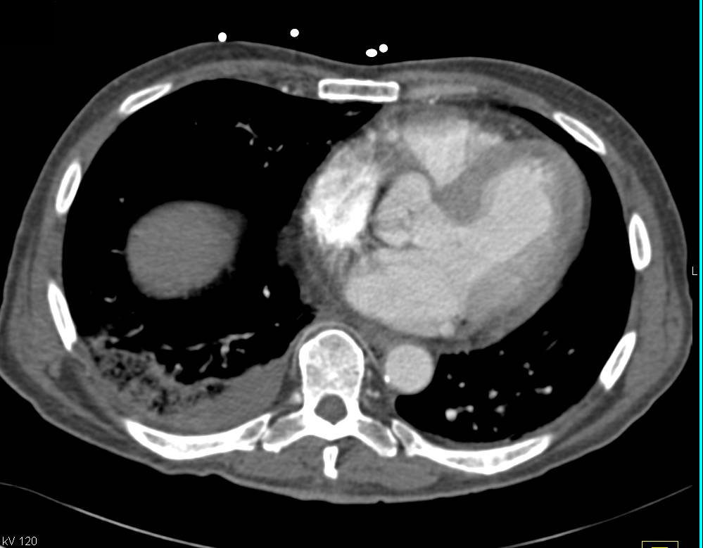 Pulmonary Embolism with Infarcts in the Lung, Liver, Spleen and Kidney - CTisus CT Scan