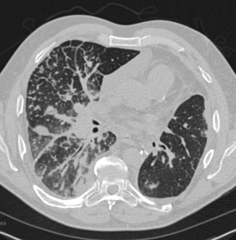 Lymphangitic Spread into the Lungs - CTisus CT Scan