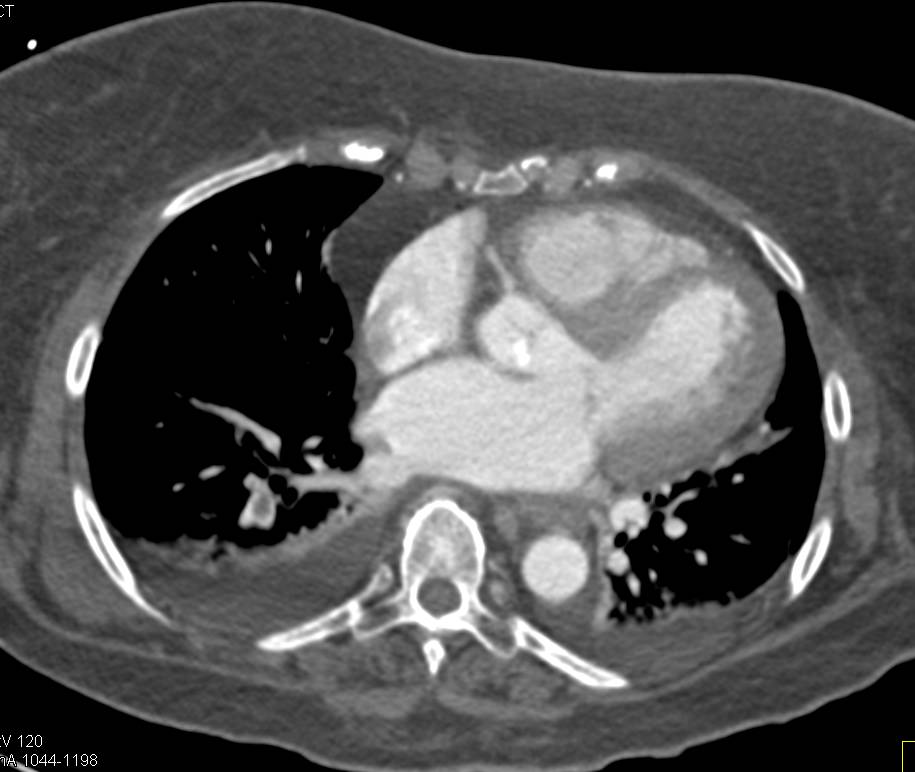 Pulmonary Embolism in Right Lower Lung - CTisus CT Scan