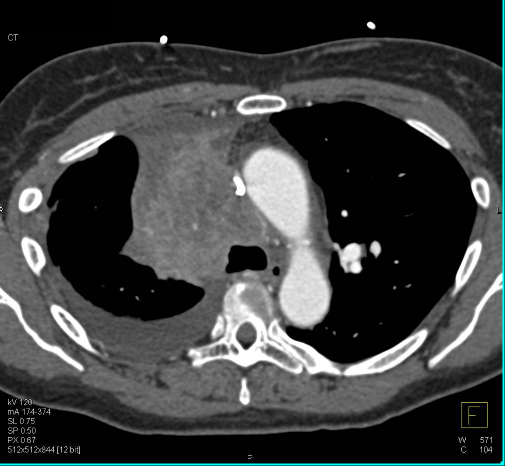 Small Cell Lung Cancer with Paratracheal Adenopathy and Superior Vena Cava (SVC) Occlusion and Adrenal Metastases - CTisus CT Scan