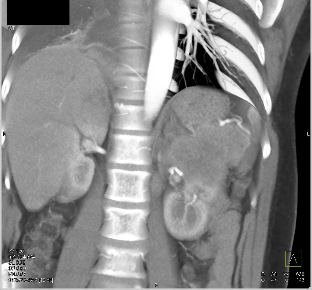 Small Cell Lung Cancer with Metastases to Adrenal, Kidney and Pancreas - CTisus CT Scan