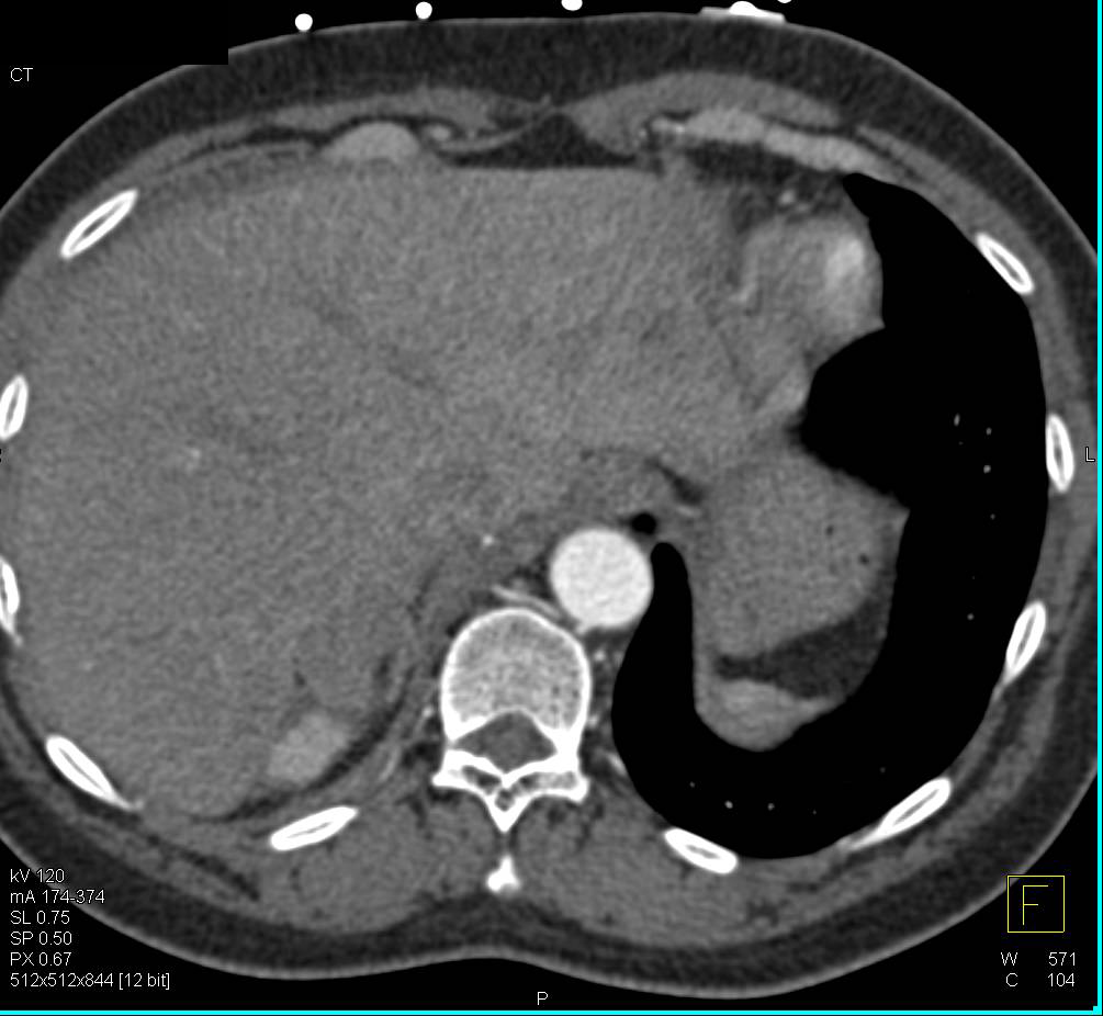 Small Cell Lung Cancer Superior Vena Cava (SVC) Occlusion and Encased Right Pulmonary Artery - CTisus CT Scan